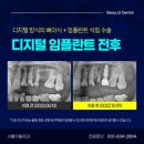 임S플란트치과의원 | 여주임플란트, 상악 어금니 3개를 잃은 환자 후기(ft. 디지털 네비게이션)