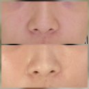 삼성동-3 | 삼성동 피부과 3차 하이드라페이셜 매끄닝 후기 내돈내산