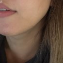 국산1로 | 자연스러운 입술볼륨 국산필러 입술필러 전후 후기