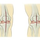 인공관절, 무릎인공관절 이미지