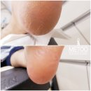 나도손톱 레푸스 개봉점 이미지