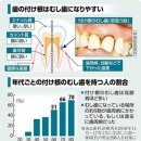 충치로 이가 부러진다？ 조기발견하면 깎지 않고 고칠 수 있는 경우도 이미지