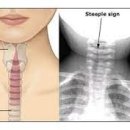 급성 후두염 및 기관염[acute laryngitis, tracheitis] 이미지