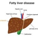 비알콜성 지방간 원인 해결 방법 이미지