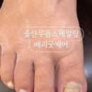베리굿케어울산내성발톱무좀