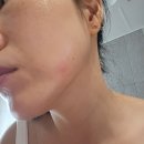 원나잇 | 간지러운여드름 트러블 성인여드름 마그네슘패치추천 내돈내산 원나잇트러블패치효과 솔직후기