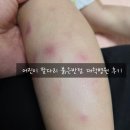 7살 어린이 팔,다리 붉은반점. 대학병원 가보니 동전습진 이였어요. 3개월 후기. 원인,증상