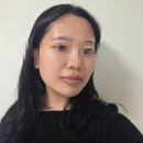 희망메디칼 | 입술필러 국산 1cc 자연스러운 강남역성형외과 통증 후기