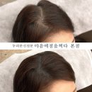 점찍다 | 광주 M자두피문신·SMP전문 “광주두피문신 마음에점을찍다 본점” 후기