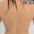 주식회사 다온다옴 | 청담피부과추천 바디온다리프팅 7일차 후기 40대 군살제거(효과, 통증, 부작용, 전후)