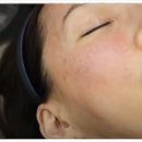 이고은피부과의원 | [피부과 전문의] 리쥬란힐러 시술시 엠보싱은 필수일까? 리쥬란 후기 셀프 시술로 알려드리겠습니다.