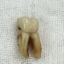 굿초이스치과의원 | [공지] 금이 간 치아를 방치하게 되면 어떻게 될까요? [지족동 굿초이스치과]