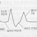 칼륨(k+)과 고칼륨혈증(hyperkalemia) 이미지