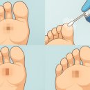 에스비피부과의원 | SB피부과에서 티눈 냉동치료 진짜 후기. 진짜 아픈가?(티눈 사진 있으니 비위약하신분은 클릭 금지)