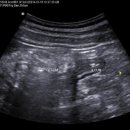 cecum diverticulitis 이미지