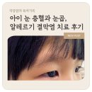 봉담도담소아청소년과의원 | 아이 눈 충혈과 눈곱 - 알레르기결막염