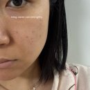 부산 덕천 올리브 피부과 쥬베룩 주사 후기 - 2