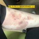 신대생생한의원 | [피부질환 치료후기] 화폐상습진 치료 과정, 개인적 후기. 사진 있으니 주의 (불펌금지)