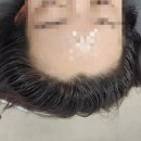 장백로 | 일산헤어라인 문신 고민 끝! 묵연뷰티 일산점 헤어라인 결기법 후기