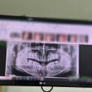 하늘채부부치과의원 | 대연동 치과 추천 과잉 진료 없는 수부부치과 후기 (충치치료, 사랑니 발치)