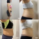 명동다이어트병원 복부지방분해주사 솔직 후기