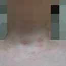 더샤인한스의원 | 내돈내산 얼굴,목 잡티 제거 창동[더샤인한스클리닉]