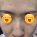 뉴대구사우나 | 대구플라즈마 반월당역에스테틱 추천 모공관리 콜드플라즈마 사마귀 제거 케어후기