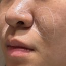 청담큐비큐의원 | 청담 피부과 쥬베룩볼륨 팔자주름 2cc 효과 통증 후기