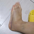 [정형외과] 수유다나은정형외과 #발목인대파열치료