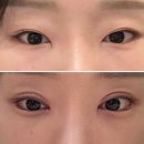 신정형외과의원 앞 | 신사역성형외과 눈재수술 절개 쌍꺼풀 앞뒤밑트임 한달 후기