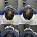 그레이시티 광주직영점 | 광주 두피문신 잘하는 곳 그레이시티 광주직영점 후기