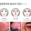 홍조