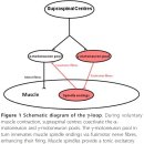 퇴행성 관절염에서 대퇴사두근 위약, 위축이 발생하는 이유는? 관절기원성 근억제(arthorgenic muscle inhibition) 그리고 그 해결책 이미지