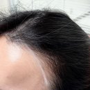 강남 헤어라인 두피문신 무니 smp 내돈내산 찐후기