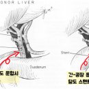 성인 간이식 후 발생하는 담도계 합병증 이미지