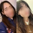 프라임여성의원건물 | 여성 헤어라인 모발이식 2개월~9개월차 리얼후기(모프로의원)