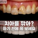 고려치과병원 | 미니쉬 후기 총정리! 치과병원 추천 및 가격