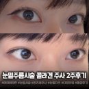 청담피부과 눈밑주름시술 리즈네+아이비타민 콜라겐주사 후기