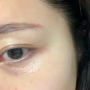 오로라의원 | 전주 만성동 사마귀, 한관종, 비립종, 여드름 문제성피부전문 | 오로라숲