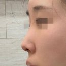 제이티성형외과 코성형 11개월차 후기! 이미지