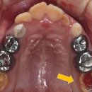 어금니-앞니 저광화[Molar-Incisor Hypomineralization (MIH)] 이미지