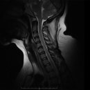 Re: Re: 목디스크 완치로 통증치료 혁명 책에 꼭 넣어야 .. 경추성 어지러움 통계 이미지