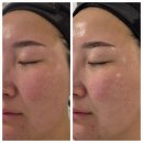 화곡동피부관리 한자리에 15년 영업하시고 홍조피부를 맑게 만들어준 힐링연구소 후기