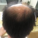 모발이식후기 성공플랜짜긔