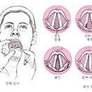 성대결절 초기 증상 성대마비 원인 치료 신경손상 이미지