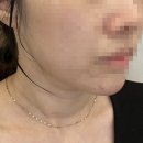 홍대피부과 목주름필러 선천적 가로목주름 벨로테로 후기