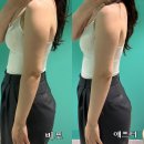 [강남 다이어트 한의원] 팔뚝 리바이브 바디리프팅 1회차 효과 후기
