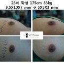 [남자유두축소수술전후] 26세 학생 175cm 83kg 9.5X10X7 mm → 5X5X3 mm - 2 이미지