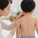 차유슈퍼 | 여름철 아기 땀띠 관리 방법, 옷·목욕·실내온도까지 체크할 기준