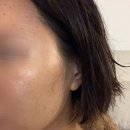 더기능가정의학과의원 | [이삭가정의학과의원] 편평사마귀 레이저 1~7일차 후기/제거 후관리 방법(+재생크림,연고추천)